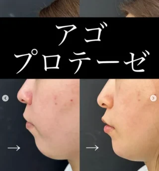 アゴプロテーゼ