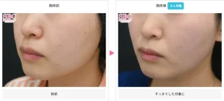 Aquicell（アキーセル）脂肪吸引