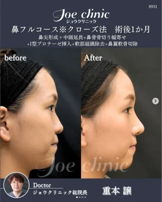 鼻フルクローズ法