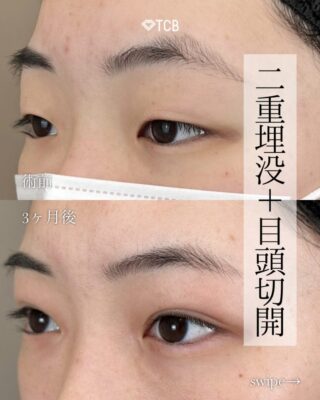 二重埋没法