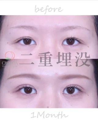 二重埋没