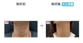 美容皮膚科（首の横ジワ）
