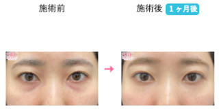 裏ハムラ法