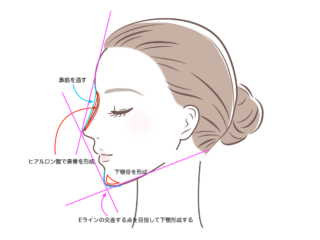 ヒアルロン酸施術イラスト