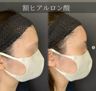 額ヒアルロン酸注入
