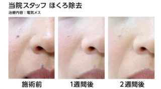 ホクロ除去
