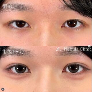 二重埋没法