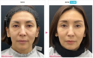 コンデンスリッチフェイス脂肪注入全顔入れ放題・VOV(ボブ)リフト・眉下リフト(眉下切開)