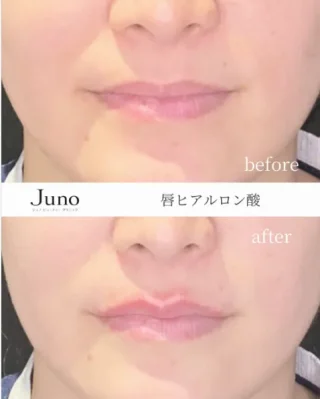 唇ヒアルロン酸 ジュビダーム