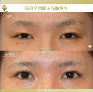 両目全切開・脂肪除去
