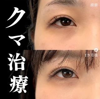 切らない目の下のクマ取り・たるみ取り