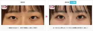 線留めクロス二重術
