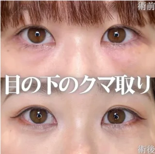 クマ取り
