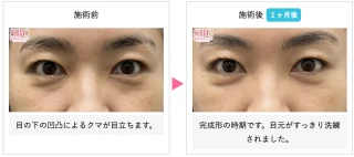 裏ハムラ法