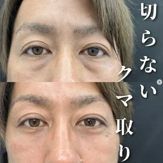 目の下のふくらみ取り