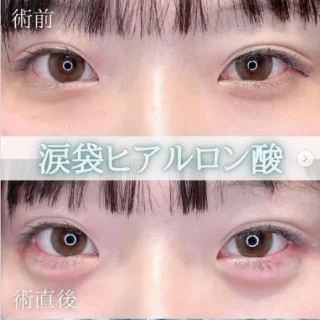 涙袋ヒアルロン酸注射