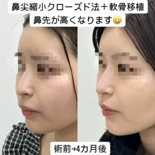 鼻尖縮小クローズド法＋鼻先軟骨移植セット