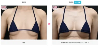 コンデンスリッチ(脂肪注入豊胸)