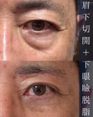目の下のクマ取り