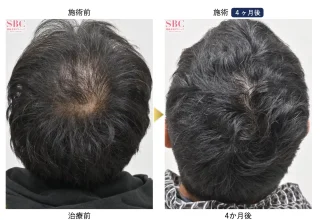 AGA薄毛治療