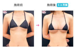 ハイブリッド豊胸 他