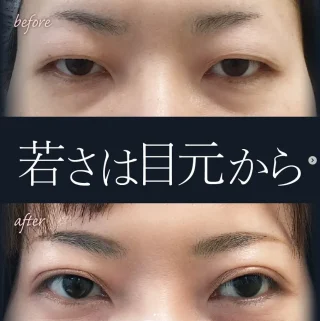 上眼瞼脂肪除去法＋切開法