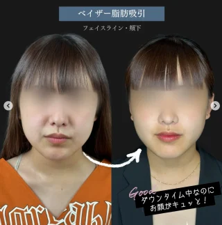 フェイスライン＋頬下の脂肪吸引