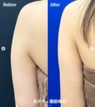 二の腕脂肪吸引