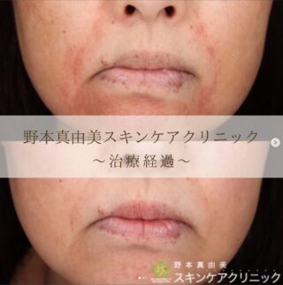 ジェネシス・スキンケア指導