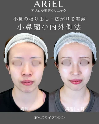 小鼻縮小内側法/外側法