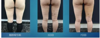 大腿全周アキーセル脂肪吸引