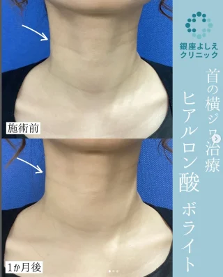 ヒアルロン酸 ボライト