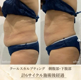 クールスカルプティング®