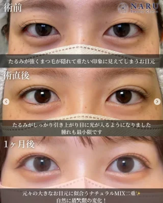 二重埋没法