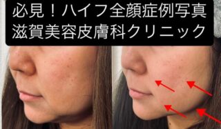 ハイフ