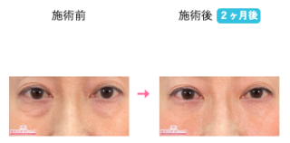 目の下の切らないクマ・たるみ（ふくらみ）取り 他