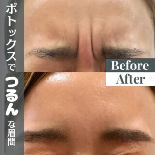 ボトックス注射