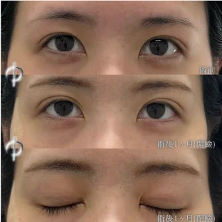埋没法(6点交叉法)