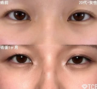 切らない目の下のクマ取り・クマ取り再生注射