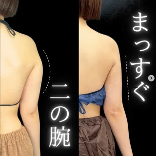 美ボディ脂肪吸引