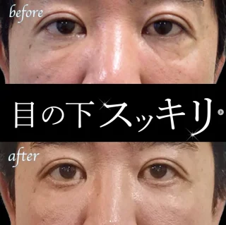 下瞼のたるみ取り＋下瞼の脂肪除去