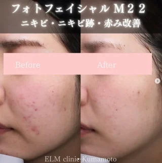 フォトフェイシャル6回