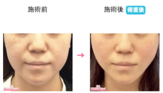 小顔若返りリフト 他