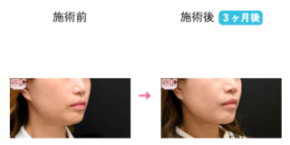 シークレットリフト 他