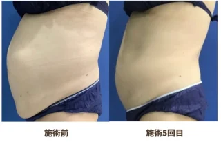 脂肪冷却痩身(クールテック)
