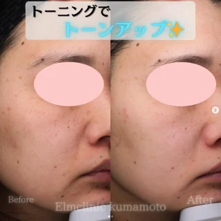 トーニング5回コース