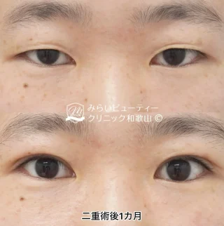 埋没法二重術(ダブルループ留め4点固定)
