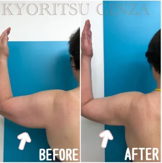 二の腕の脂肪吸引