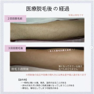 医療脱毛