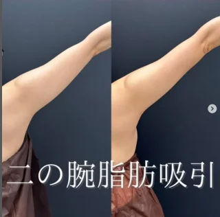 二の腕+肩脂肪吸引